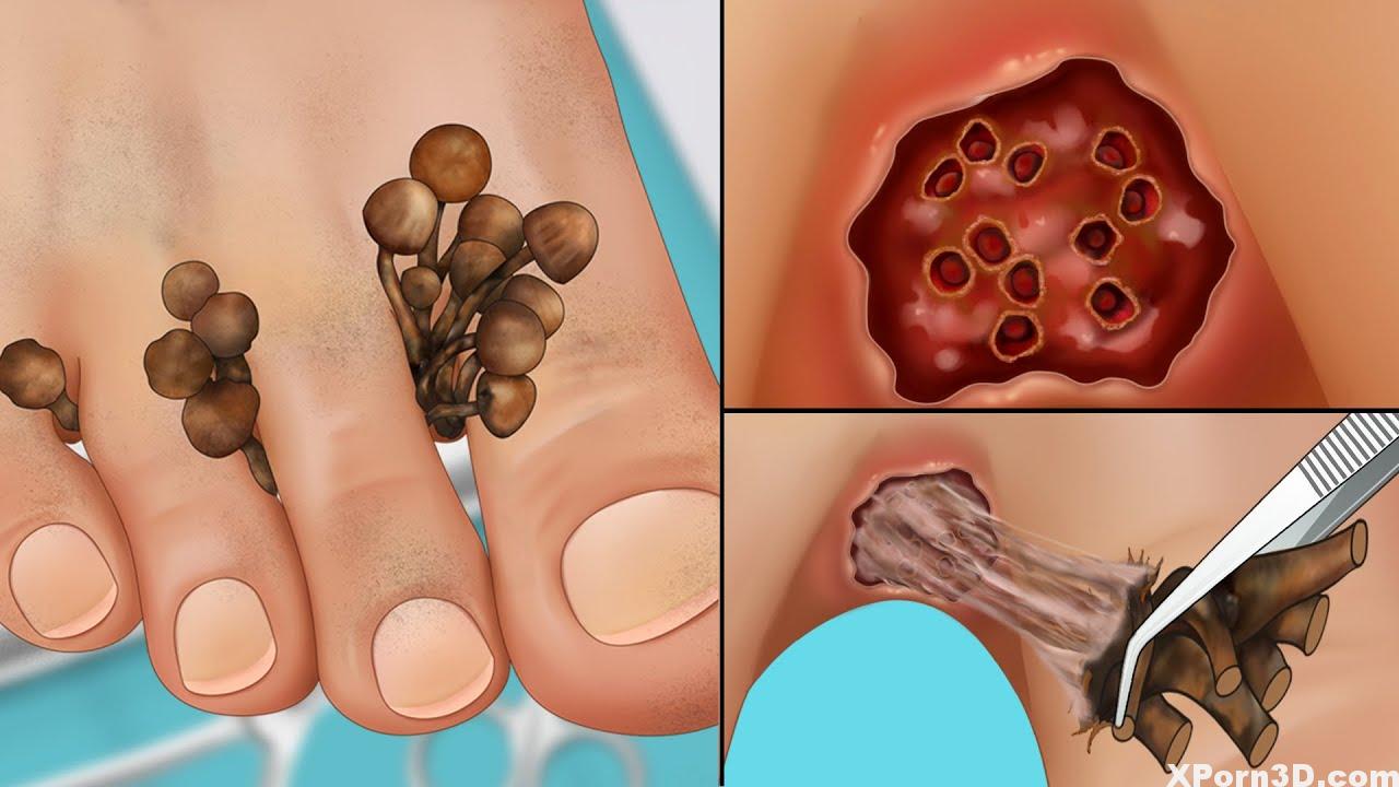 ASMR Take away fungal an infection between toes | Foot care therapy animation