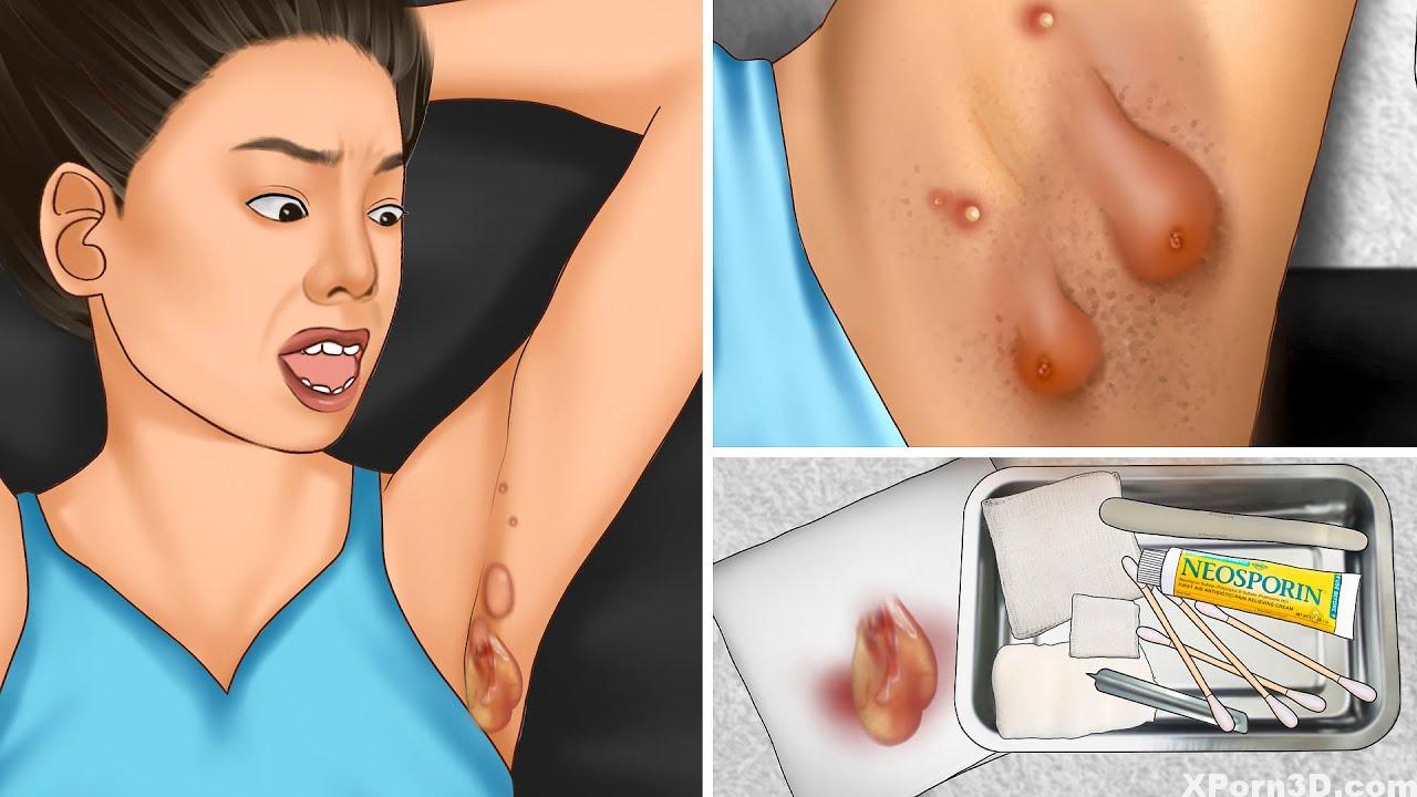 ASMR Take away armpit massive pustule and pimple popping | Pimples underarm animation
