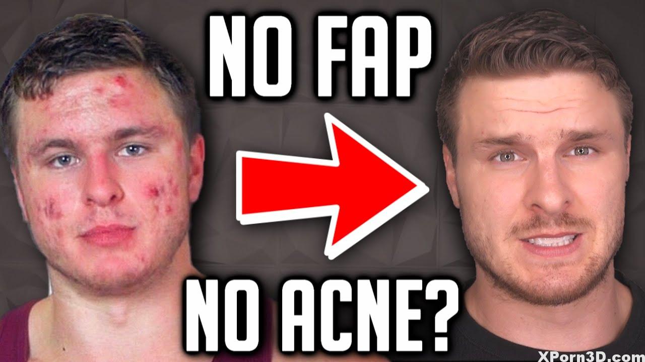 DOES MASTURBATION CAUSE ACNE?  (My Expertise…)