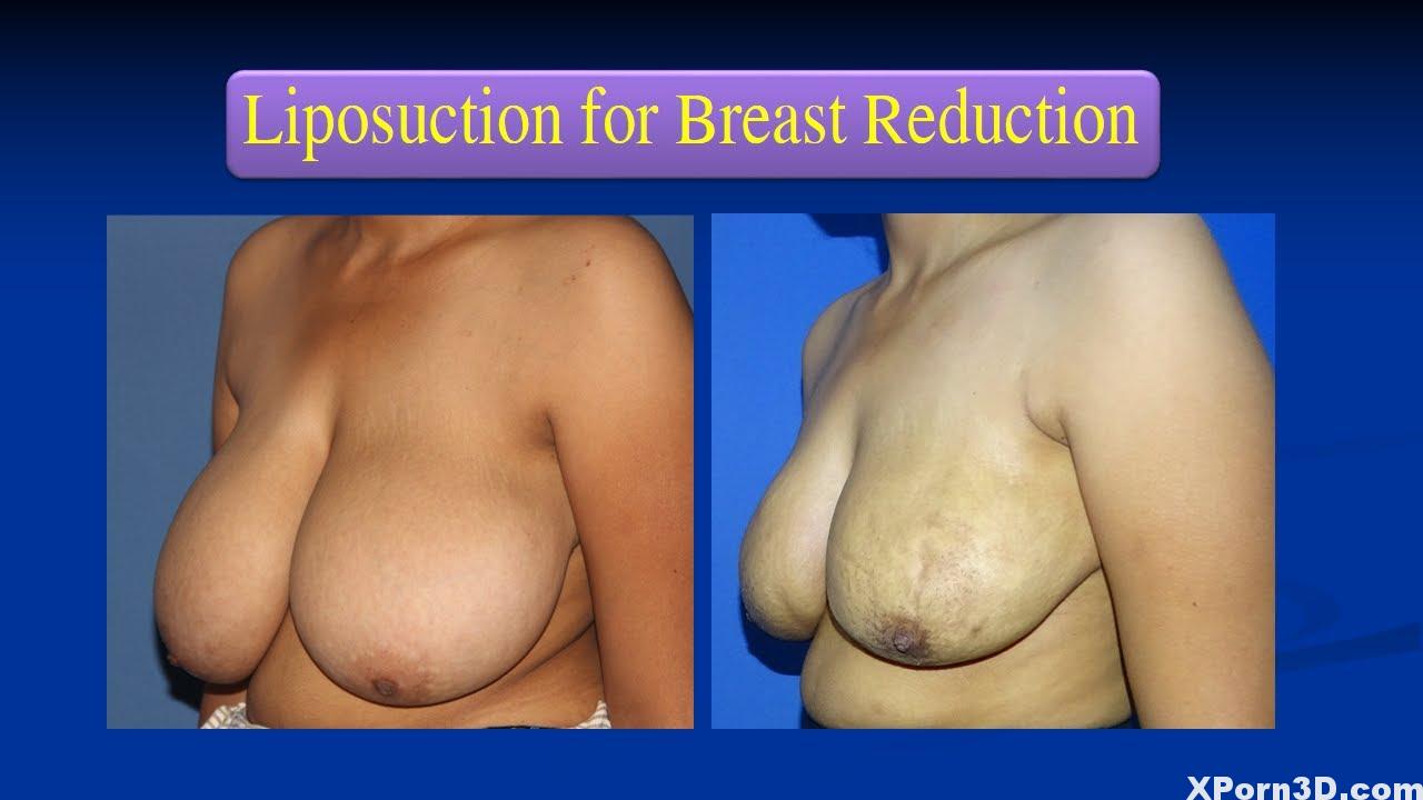 Breast Discount with solely Liposuction for enormous breasts : scarsless , easy & price efficient